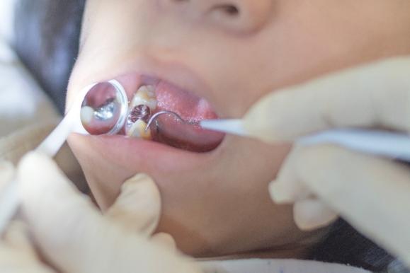 proche en haut de dentiste vérification patient avec excavatrice et  dentaire miroir, dentiste vérification patient avec excavatrice et dentaire  miroir, patient vérifié par dentiste, dentiste Faire dentaire vérification  27613710 Photo de stock